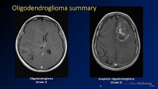 Imaging brain tumors  3  Oligodendrogliomas [upl. by Rochus664]