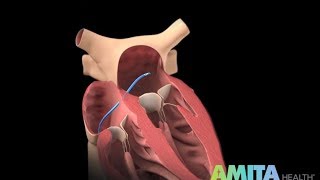 What Is Catheter Ablation — AMITA Health [upl. by Ubana]