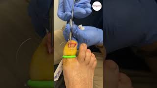 Ingrown Nail Surgery [upl. by Yrmac]