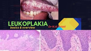 Leukoplakia histopathology [upl. by Okoy]