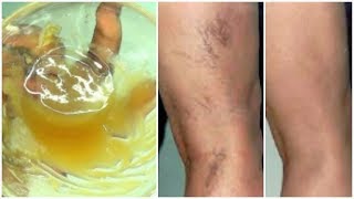 LOOK WHAT I USE ON MY VARICOSE VEINS  SPIDER VEINS GET RID OF VARICOSE VEINS FAST Khichi Beauty [upl. by Chet]