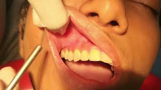 Administration of dental local anaesthesiabuccal infiltration technique endodontics dentistry [upl. by Hsekin449]