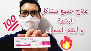 وداعا لحب الشباب و البقع الحمراء و الاكزيما بمرهم لوكابريد 01 Locapred [upl. by Catlin623]