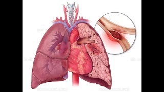 PULMONER EMBOLİ KONU ÖZETİREVİZE [upl. by Glanti]