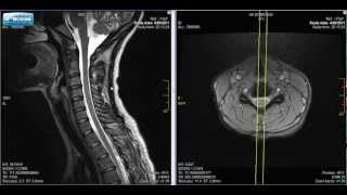 Normal Cervical Spine MRI Explained  Dr Jeffrey PJohnson  HD [upl. by Ajar252]