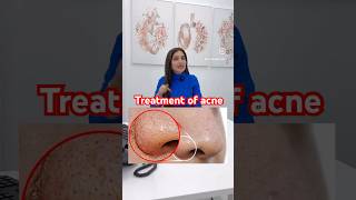 Treatment of acne and white head nose  skincare  skin therapy darkspots ​⁠DrMigraine [upl. by Lunneta]