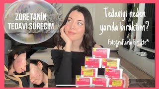 ZORETANİN TEDAVİ SÜRECİM💊  Tedaviyi neden yarıda bıraktım Yan etkileri nasıldı [upl. by Levins]