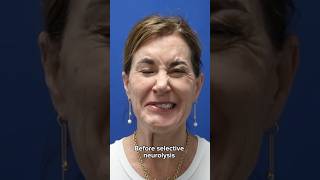 HUGE transformation after selective neurolysis surgery plasticsurgery facialparalysis facialpalsy [upl. by Hull384]