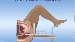 Brachytherapy for Prostate Cancer [upl. by Kristopher]