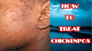 Chickenpox Treatment  How To Treat Chickenpox  Lifestyle amp Home Remedies [upl. by Christmann]