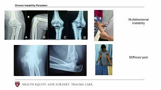 Elbow Instability [upl. by Nida]