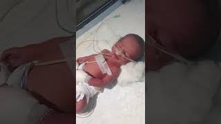 Putting feeding tube in newborn baby 🥰newbornbabycutesubscribe babytrendingshortsmotivation [upl. by Yawnoc985]