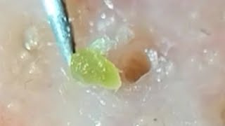 Blackheads Acorn on nose remove [upl. by Eliezer958]