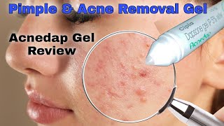 Acne amp Pimple Ke Liye Best Acnedap Gel Review in Hindi  Uses and Benefits of Acnedap Gel [upl. by Ahseinek658]