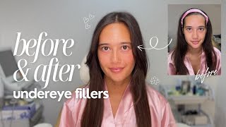 HOW TO GET RID OF EYE BAGS Before amp After Under Eye Fillers [upl. by Eydie]