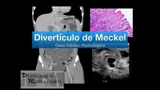 Divertículo de Meckel [upl. by Atal]