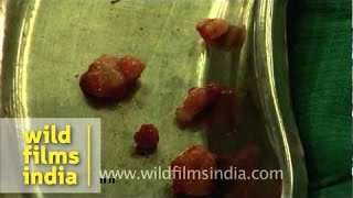 Freshly extracted cysts from the cancer infected breast [upl. by Ailen]