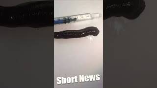 Doctors Remove Huge Leech From Boys Nose [upl. by Ainsley]