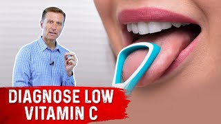 The Tongue Can Determine a Vitamin C Deficiency [upl. by Tratner]