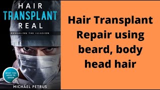 Hair Transplant repair using chest beard amp scalp hair [upl. by Alimhaj]