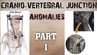 CRANIOVERTEBRAL JUNCTION ANOMALIES  PART1  SOFT TISSUE ANOMALIES  BONY ANOMALIES [upl. by Lukin]