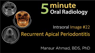 Recurrent apical periodontitis Intraoral Radiographic Interpretation [upl. by Stearns]