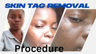 Skin tag removal procedure [upl. by Acirahs]