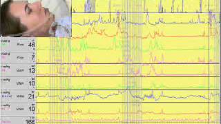 Video 1  Performing esophageal manometry [upl. by Anamor505]