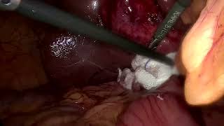 Laparoscopic cholecystectomy 24 Dure Shawar [upl. by Bettye]