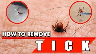 How to Remove a Tick Safely and Quickly – Tick Removal [upl. by Aneetsirhc]