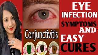 ALARMING RISE OF EYE INFECTIONS SYMPTOMSTYPESMANAGEMENT PRECAUTIONSTREATMENT OF EYE INFECTION [upl. by Anneirb]