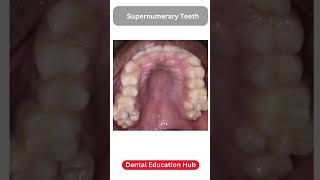 Supernumerary Teeth  Paramolar [upl. by Assiruam]