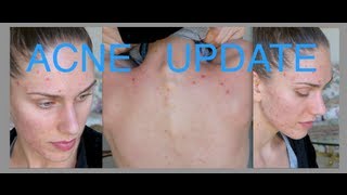 Acne Update For Acne Awareness Month Sunscreen Skincare Routine Summer amp Herbal Supplements [upl. by Navets]