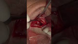 Maxillary Sinus Lift with Lateral Window Technique with Lateral Ridge Augmentation [upl. by Talich56]