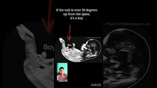 Ultrasound report Baby Boy or Girl 12 weeks Gender Reveal 🤗 shorts [upl. by Aisital]