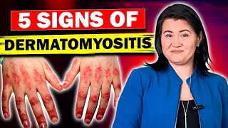 5 Signs of Dermatomyositis and Polymyositis [upl. by Atsirhc520]