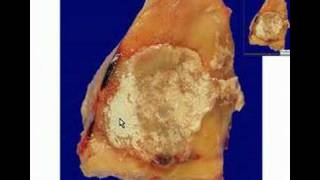 Histopathology Interphalangeal joint of toe Gout [upl. by Trela]