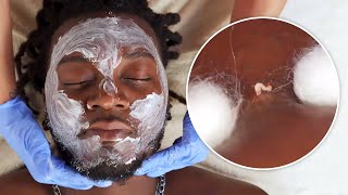 SATISFYING INGROWN HAIR  Beard Care [upl. by Neyugn]