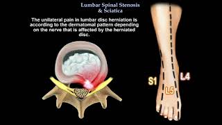 Lumbar Spinal Stenosis amp Sciatica [upl. by Maximo877]