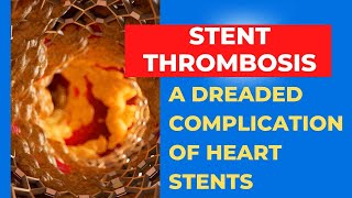 Stent Thrombosis An important complication after heart stents Part 1 [upl. by Brigida890]