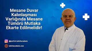 Mesane Duvar Kalınlaşması Varlığında Mesane Tümörü Mutlaka Ekarte Edilmelidir [upl. by Chuah]