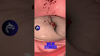 How you fix a Narrowed Heart Valve in 3D Animation valvuloplasty medicalanimation [upl. by Aisela]