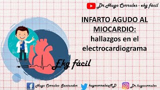 INFARTO AGUDO DE MIOCARDIO Hallazgos electrocardiográficos [upl. by Atnod]