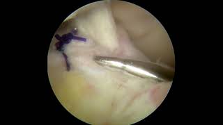 Anterior Horn Tear [upl. by Casimire551]