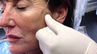 NonSurgical Face ThreadLift Procedure [upl. by Ibloc]