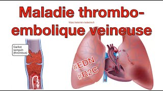 Thrombose veineuse profonde et embolie pulmonaire item 226  lessentiel à retenir pour lEDN [upl. by Ainitsirc]