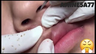 MOST SATISFYING PIMPLE BLACKHEAD POPPING For 2020 [upl. by Kurtis]