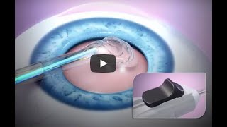 ZEPTO®️ Procedure Animation [upl. by Wadlinger]