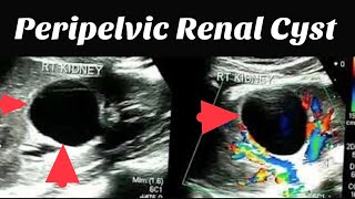 Peripelvic Renal Cyst  Kidney Cyst [upl. by Ecerahc]