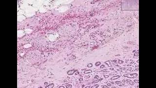 Histopathology Prostate Adenocarcinoma Gleason grade 3 [upl. by Eessac168]